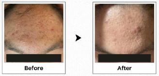 Bornderma anti-aging treatment