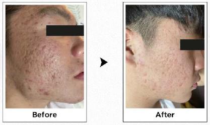 Bornderma anti-aging treatment